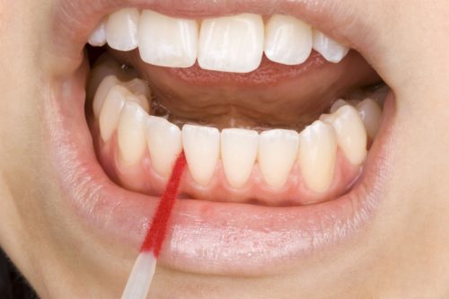 Teeth Implants Adelaide: Tips