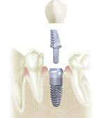 Dental Implants In Hill District: Benefits