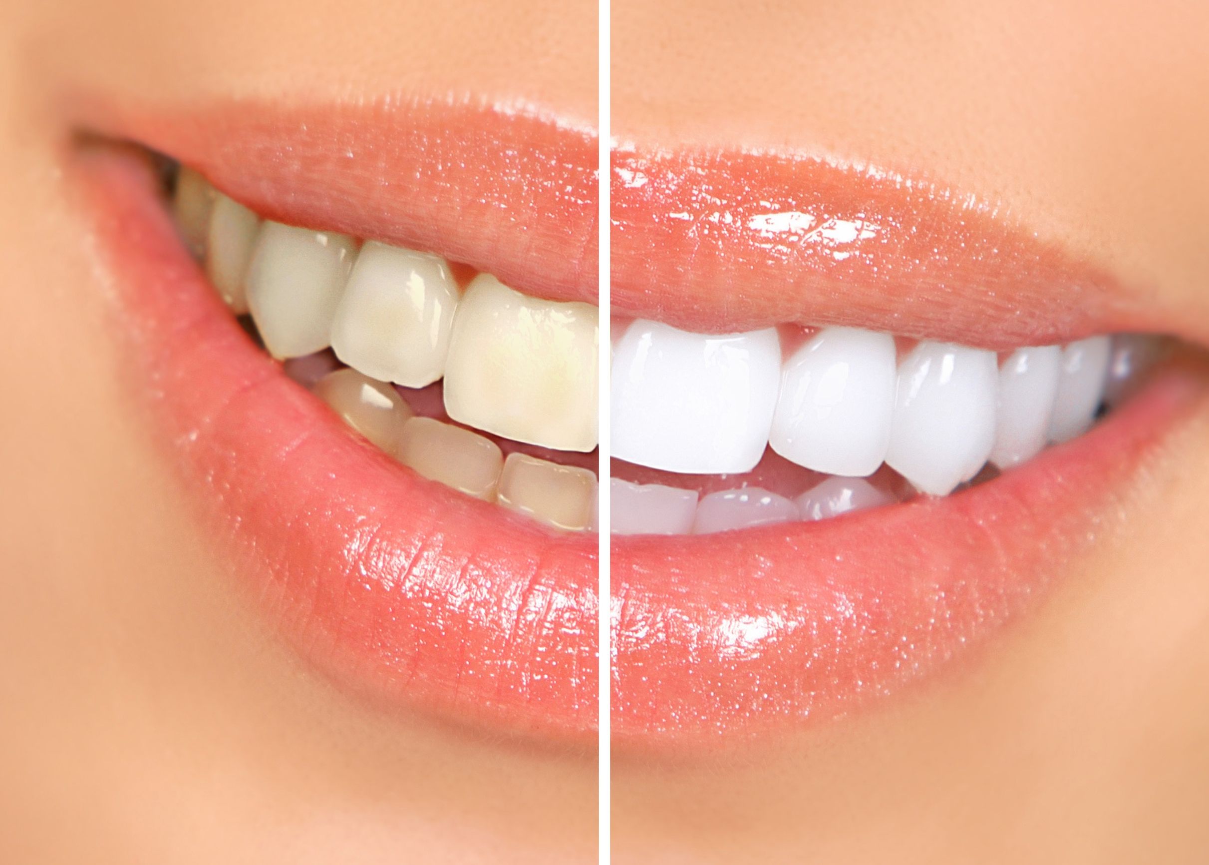 Teeth Whitening In Castle Hill: Benefits