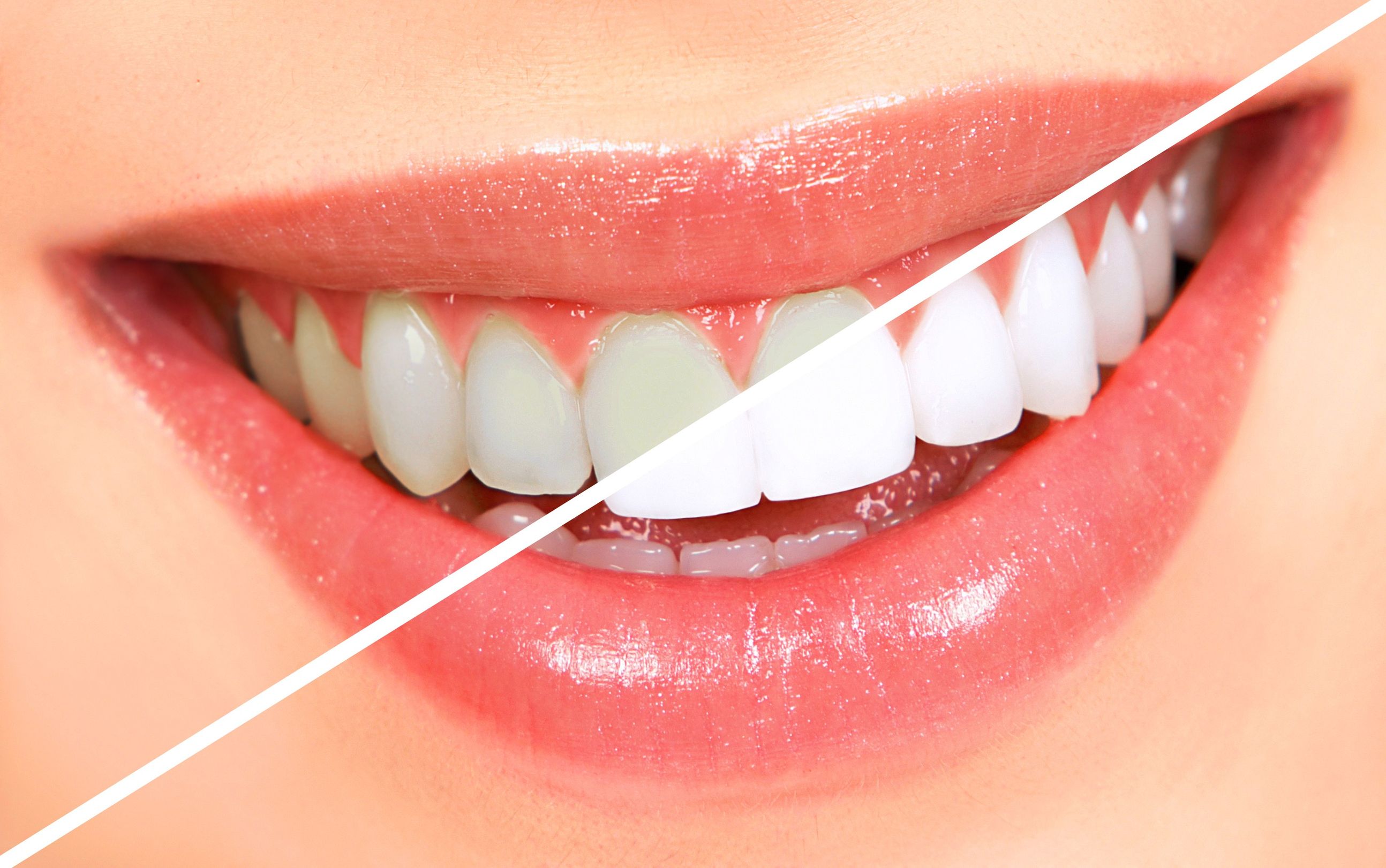 No Gaps Teeth Whitening: The Advantages